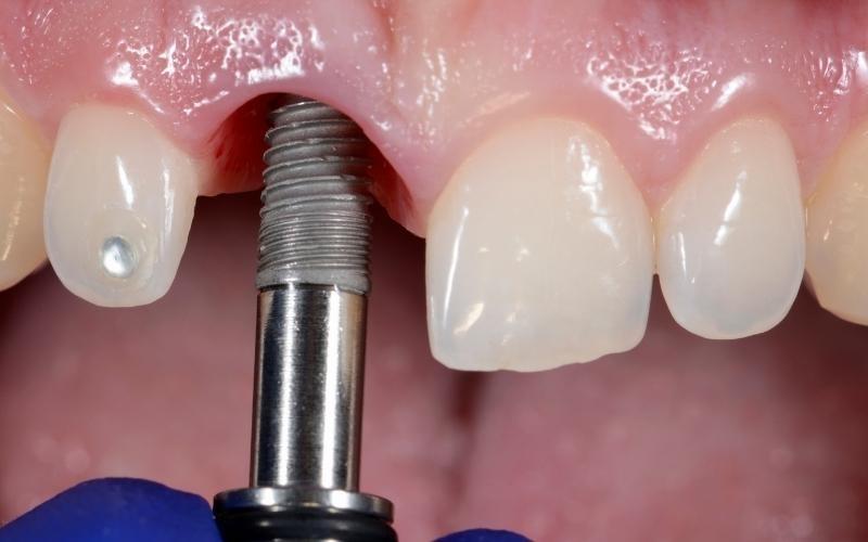 Một số lưu ý khi trồng răng implant