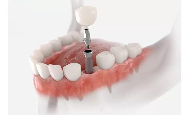 Cấy răng implant có đau không? Cách giảm đau hiệu quả