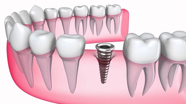 Cấy găng implant