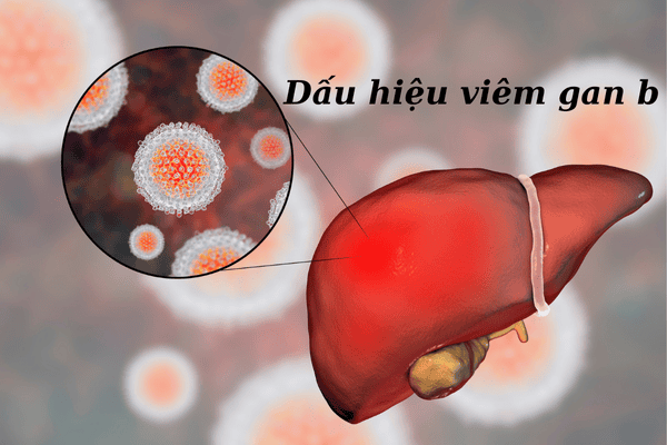 Hiểu rõ để bảo vệ sức khỏe với dấu hiệu viêm gan B