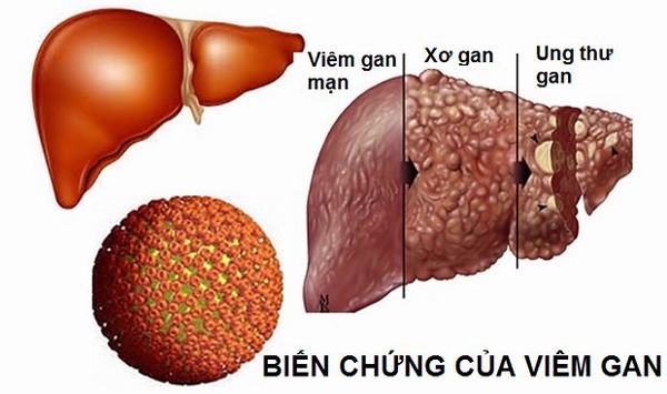 Biến chứng của viêm gan B: Những điều cần biết để phòng ngừa