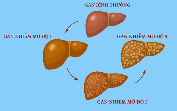 Triệu chứng gan nhiễm mỡ: Những điều bạn cần biết