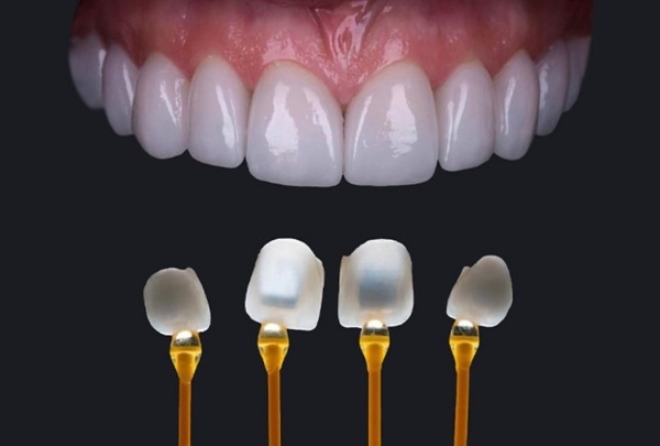 Sứ E.max: Vẻ đẹp tự nhiên tuyệt đối