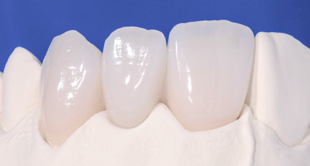 Sứ E.max và sứ zirconia: Nên chọn loại nào?