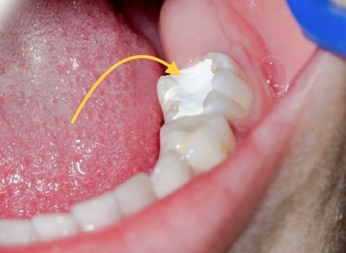 Cần bảo quản dụng cụ trám composite