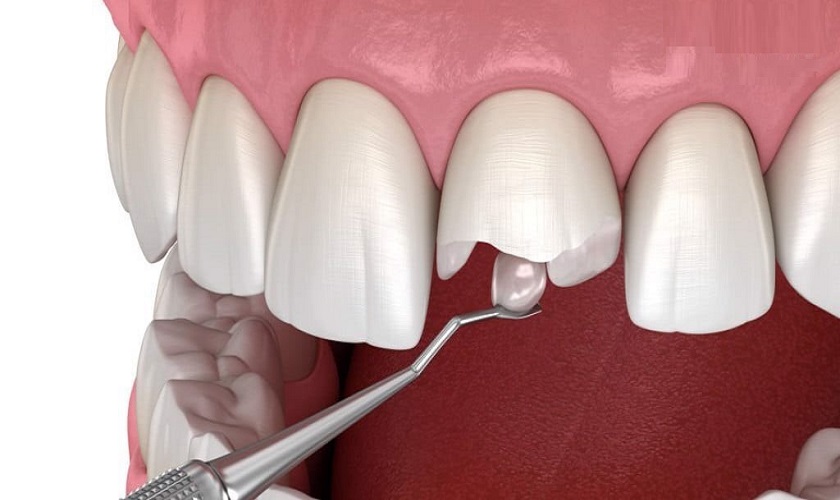 Những sai lầm thường gặp khi bảo quản dụng cụ trám composite