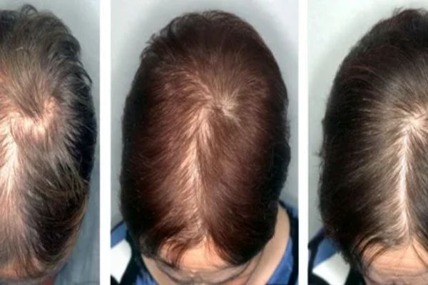 10 cách kích thích mọc tóc nam hiệu quả, giúp tóc chắc khỏe